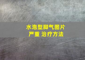 水泡型脚气图片 严重 治疗方法